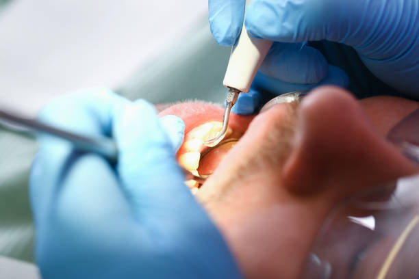 Best Emergency Tooth Extraction in North Utica, IL